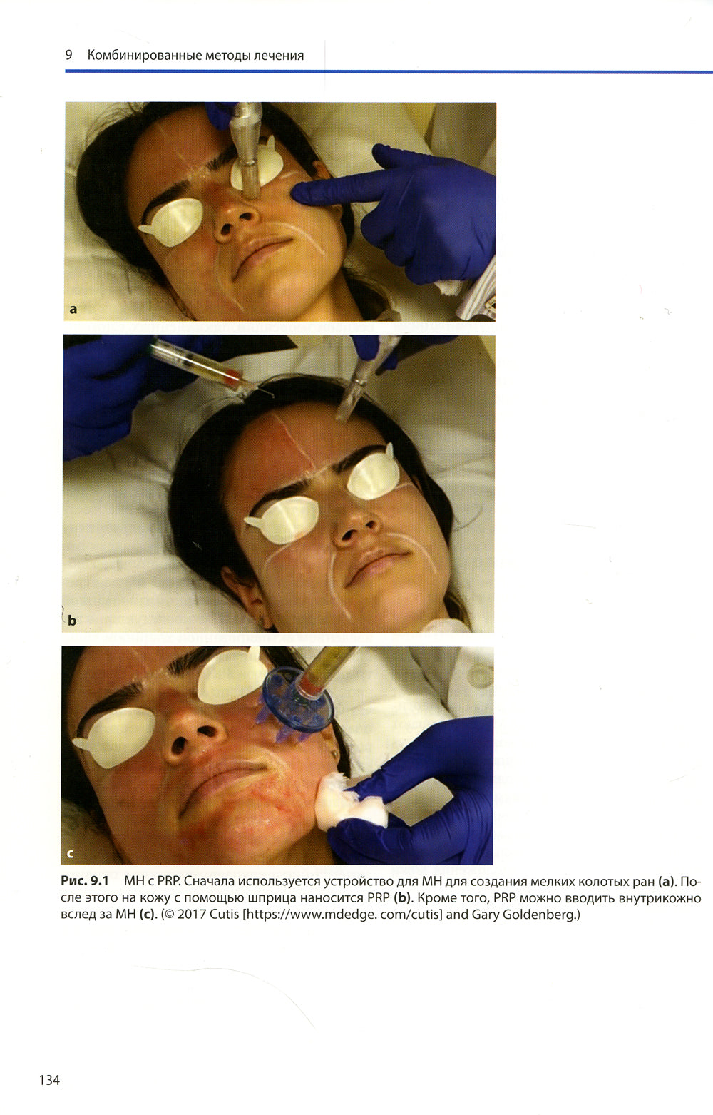 PRP и микронидлинг в эстетической медицине