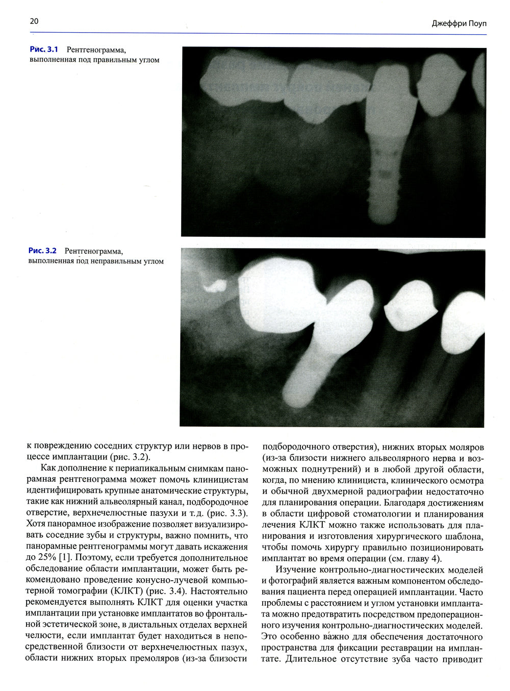 Несостоятельность дентальной имплантации