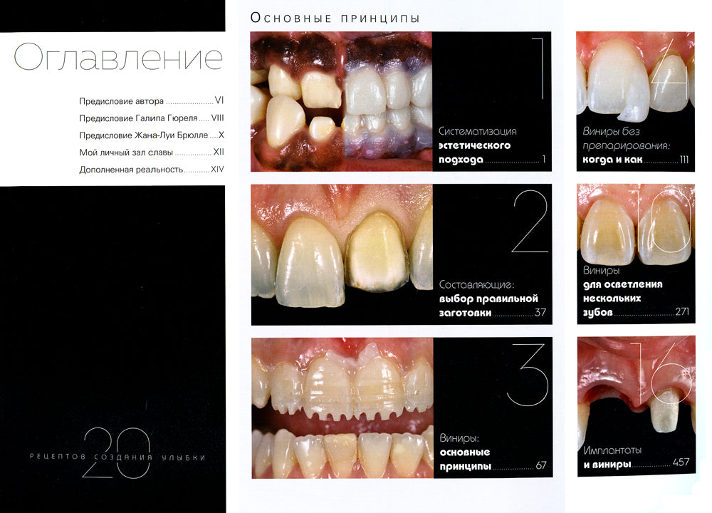 Керамические виниры