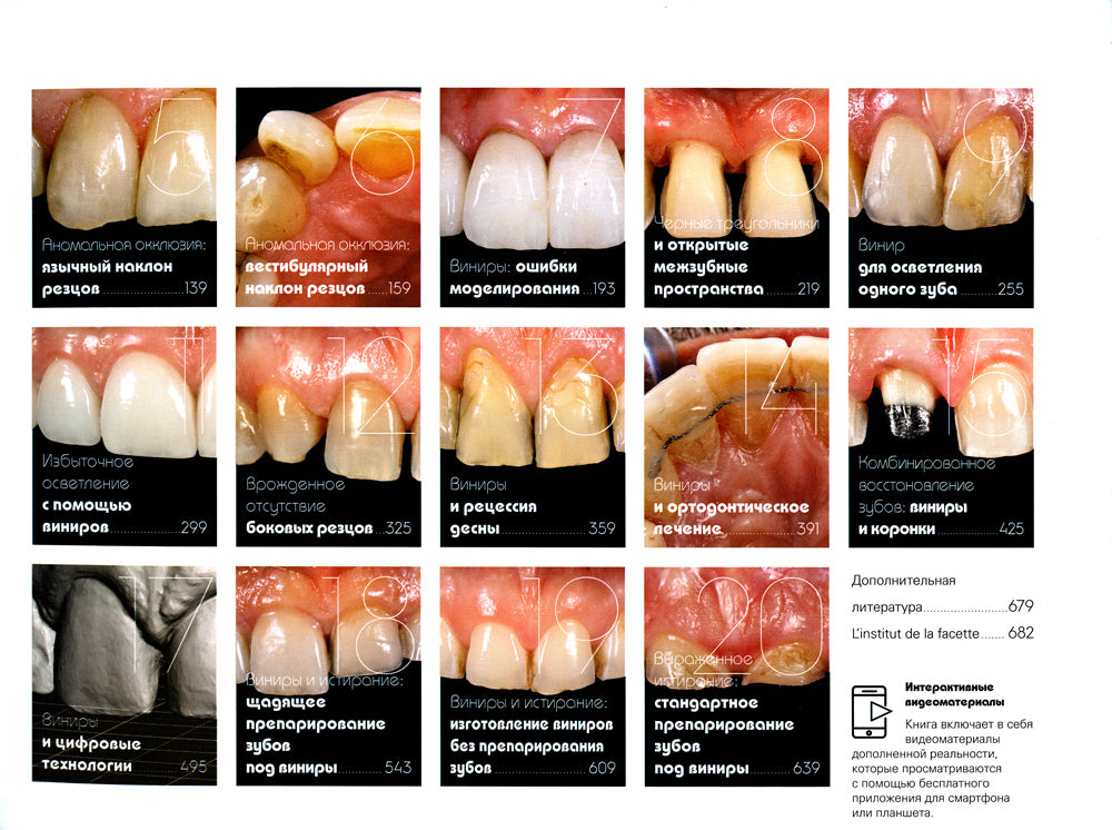Керамические виниры