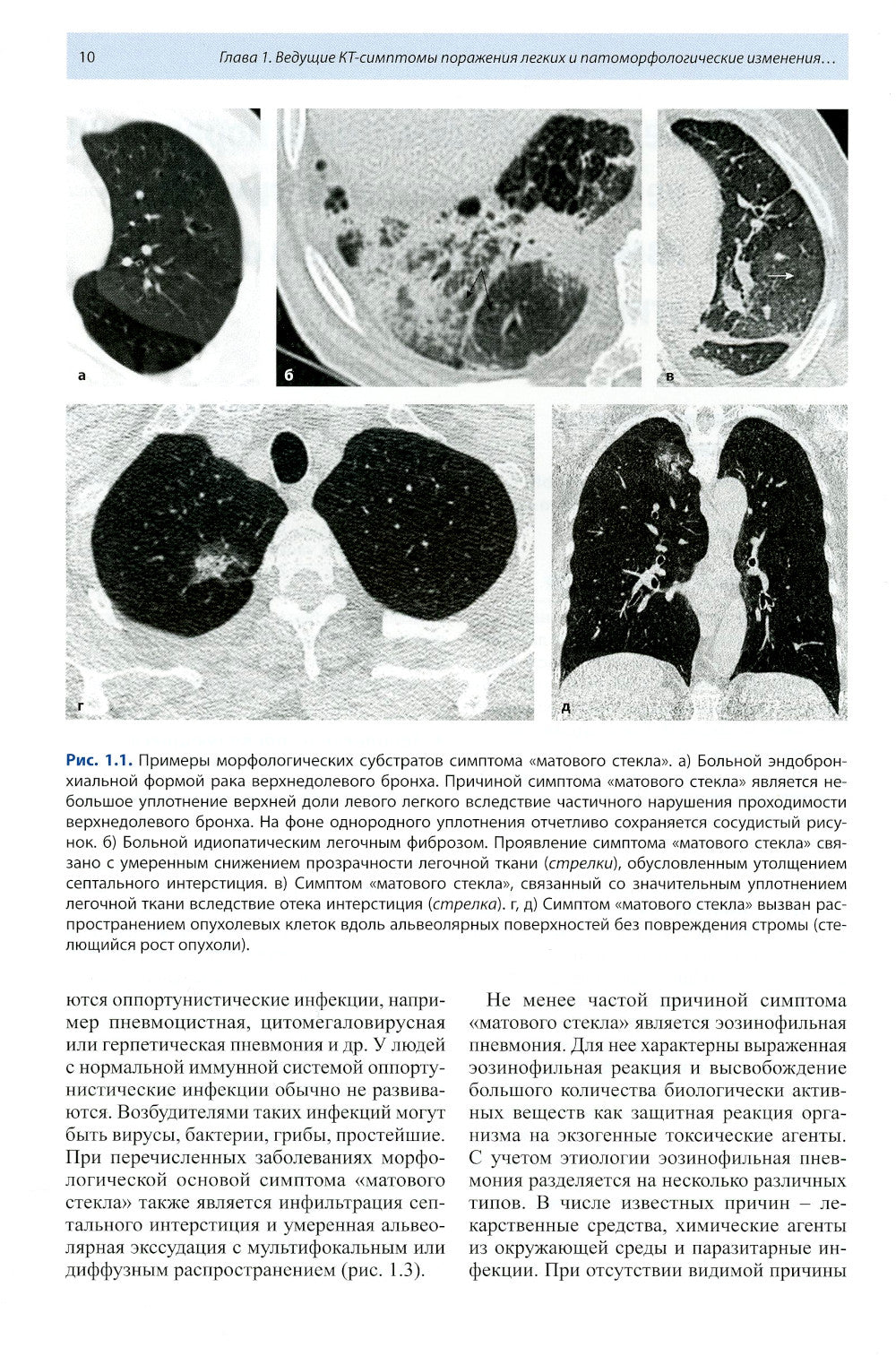 Компьютерная томография в пульмонологии. 4-е изд