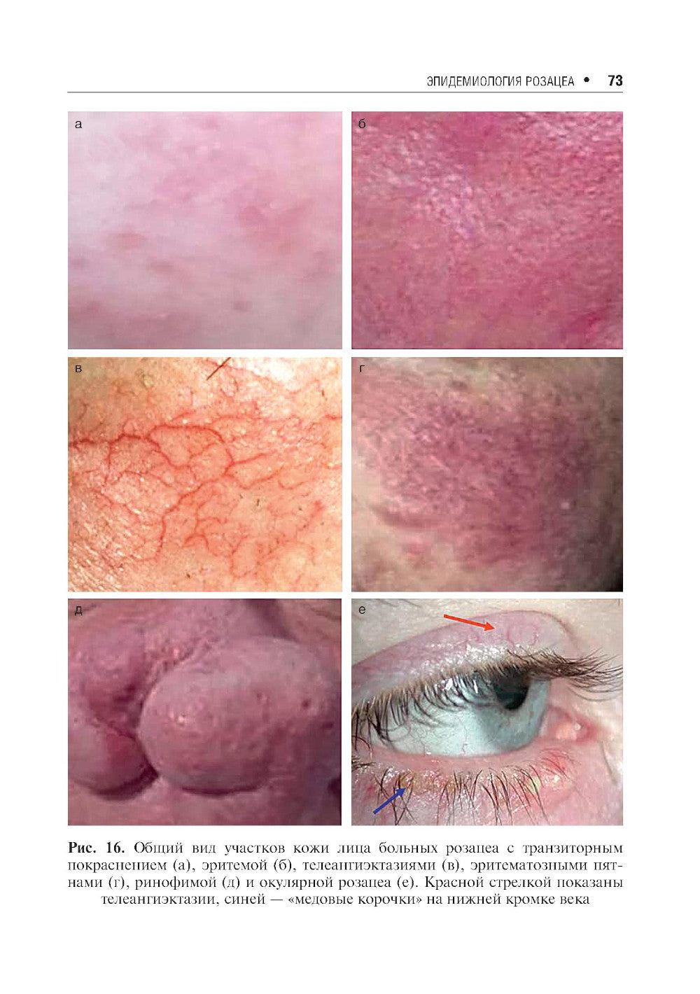 Акне и розацеа. 2-е изд., перераб. и доп
