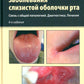 Заболевания слизистой оболочки рта. Связь с общей патологией. Диагностика. Лечение