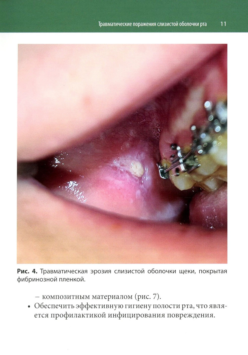 Ортодонтия и патология слизистой оболочки рта