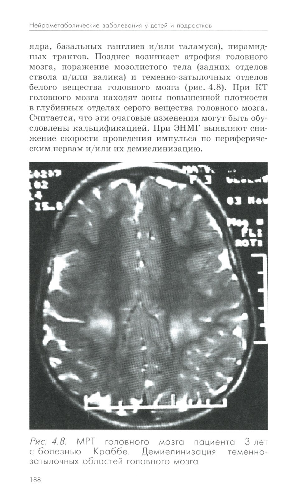 Нейрометаболические заболевания у детей и подростков: диагностика и подходы к...