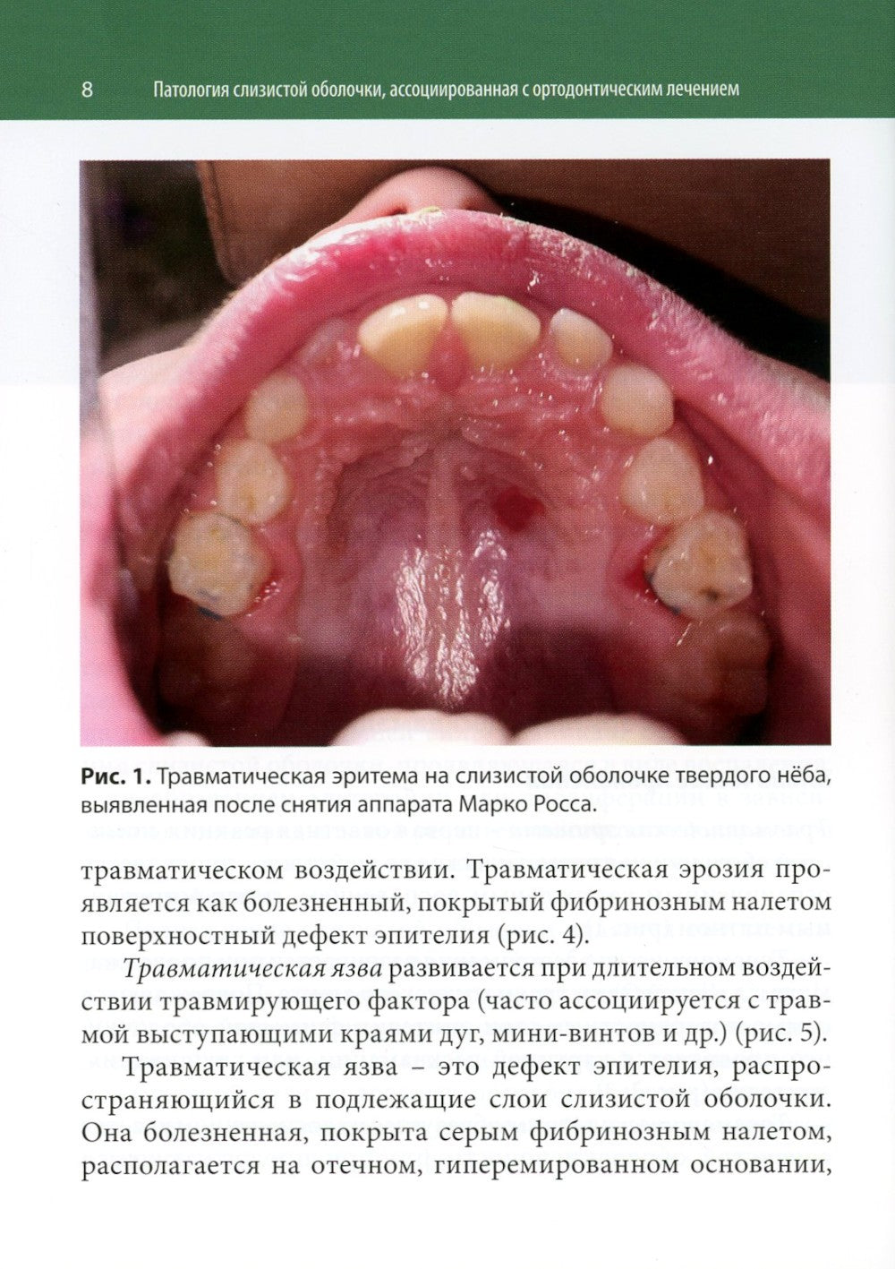 Ортодонтия и патология слизистой оболочки рта