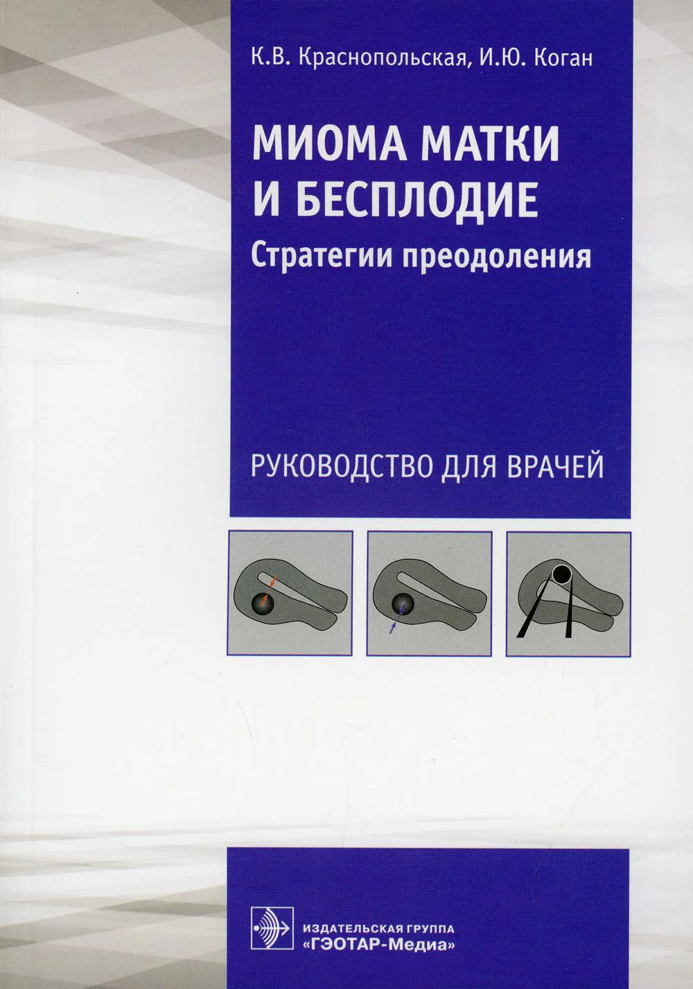 Миома матки и бесплодие: стратегии преодоления: руководство для врачей