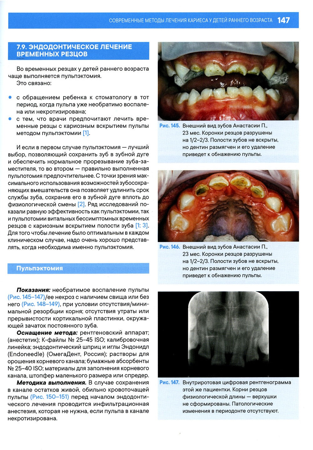 Лечение кариеса у детей раннего возраста