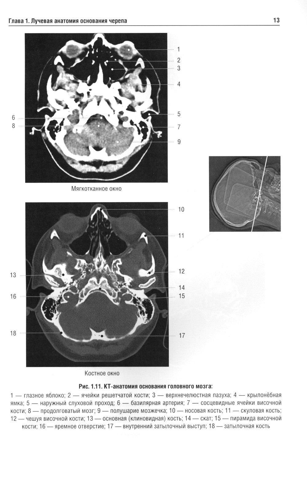 Лучевая диагностика заболеваний оснований черепа и мостмозжечкового угла: Уче...