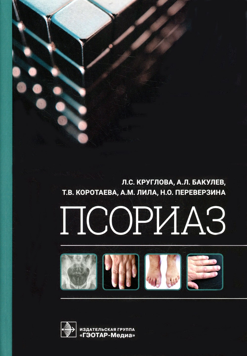 Псориаз