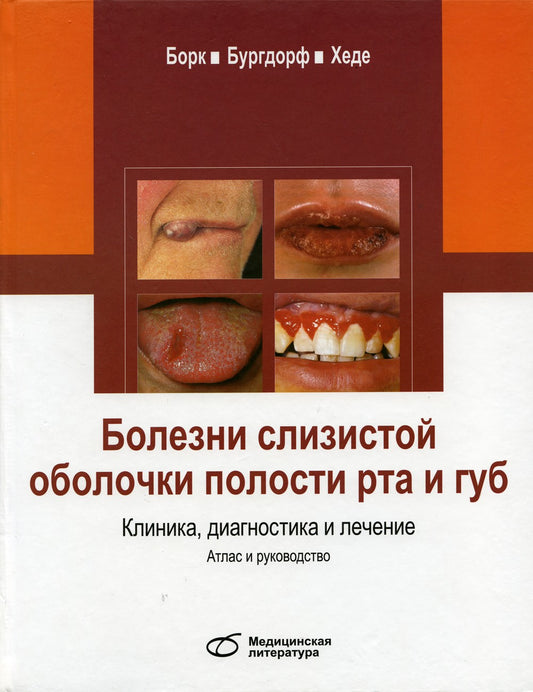 Болезни слизистой оболочки полости рта и губ. Клиника, диагностика и лечение....