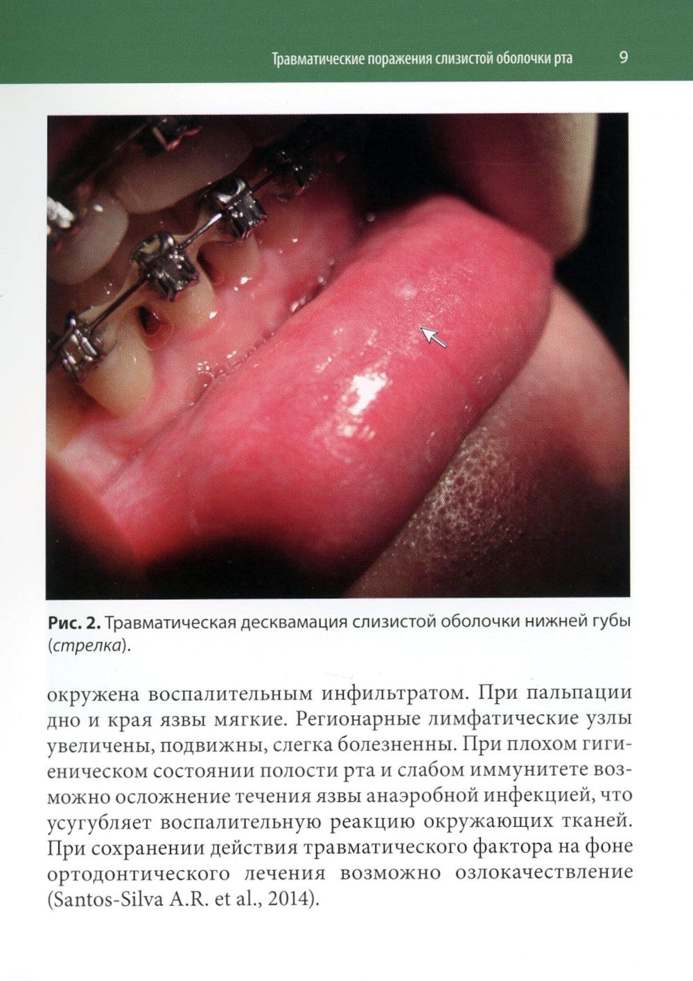 Ортодонтия и патология слизистой оболочки рта