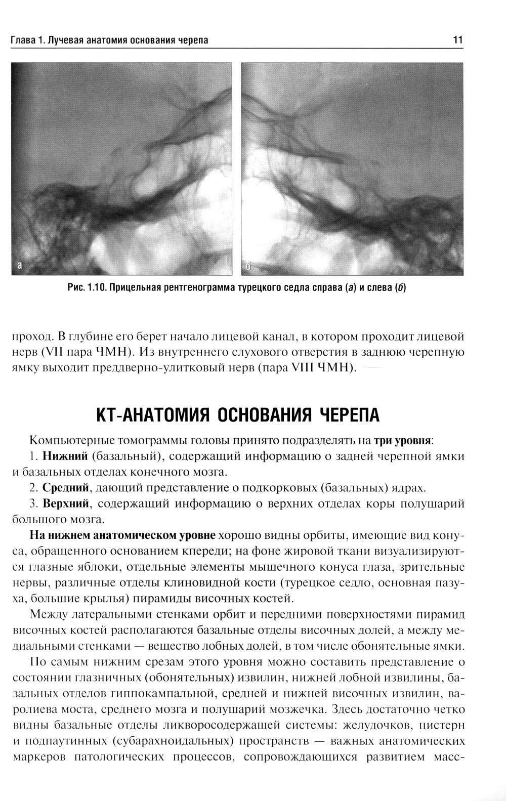 Лучевая диагностика заболеваний оснований черепа и мостмозжечкового угла: Уче...