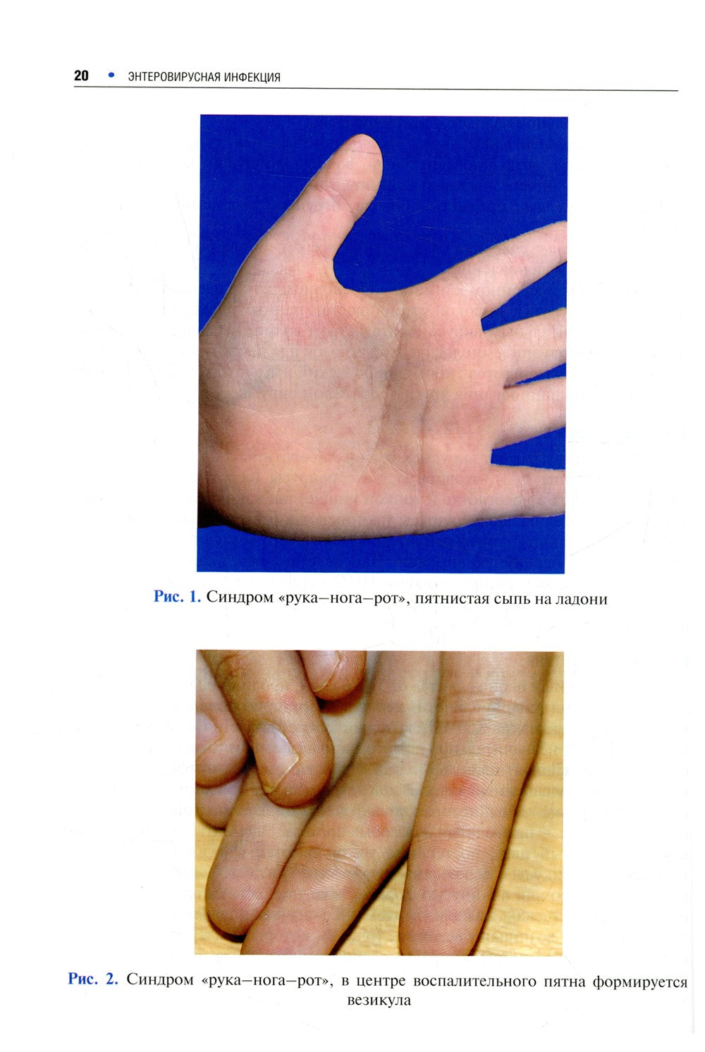 Инфекционные экзантемы у детей в практике врача-дерматовенеролога: руководств...