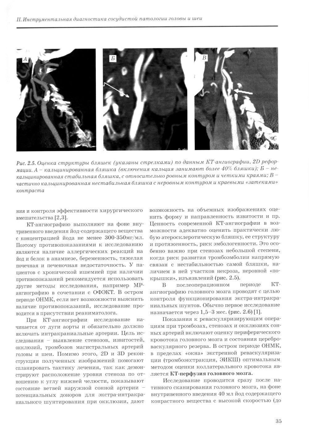 Хирургическая реваскуляризация головного мозга