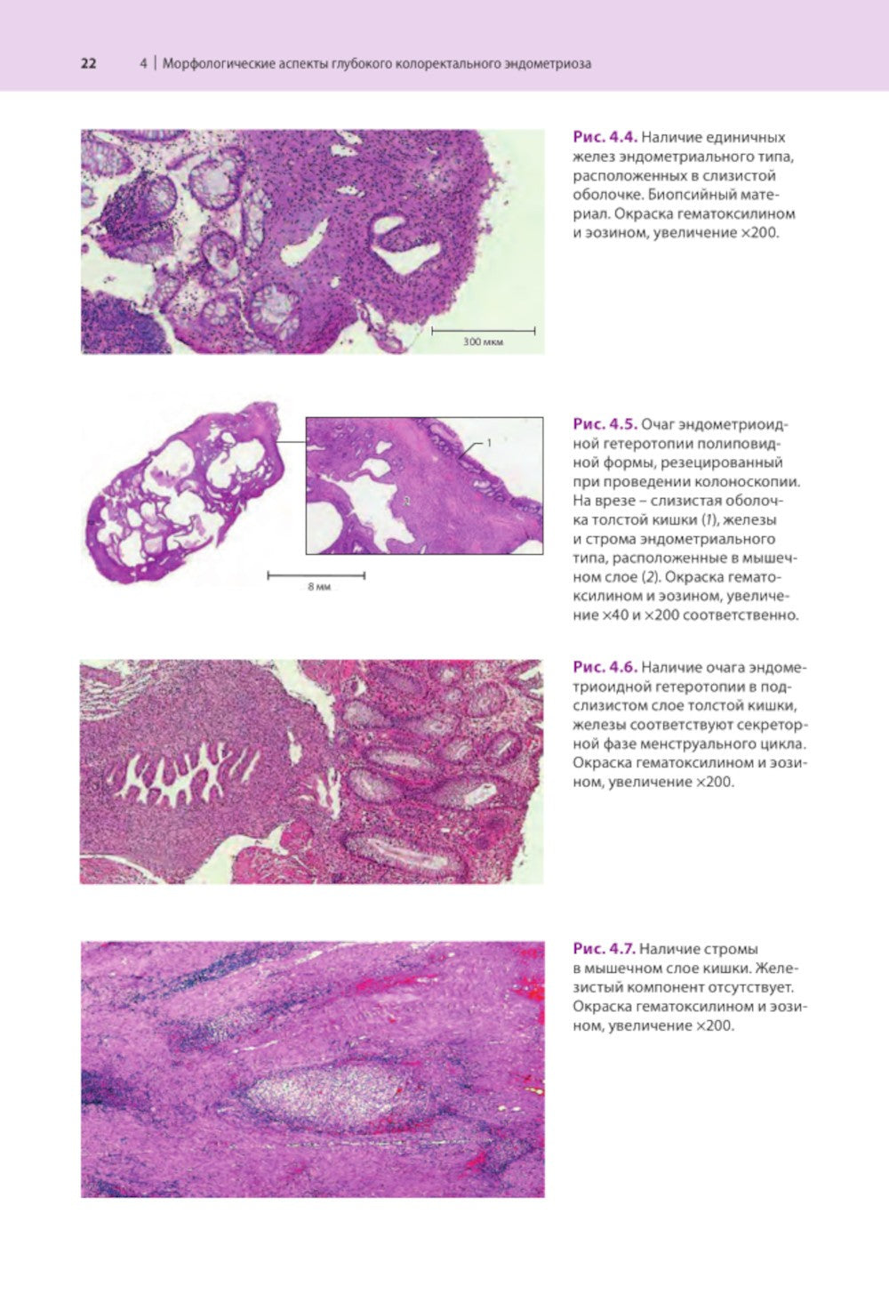 Атлас по эндоскопической диагностике колоректального эндометриоза