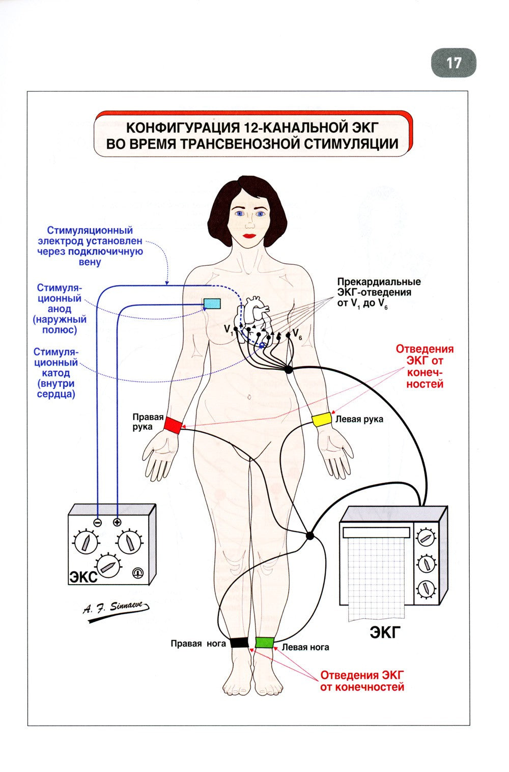 Иллюстрированное пошаговое руководство по применению кардиостимуляторов