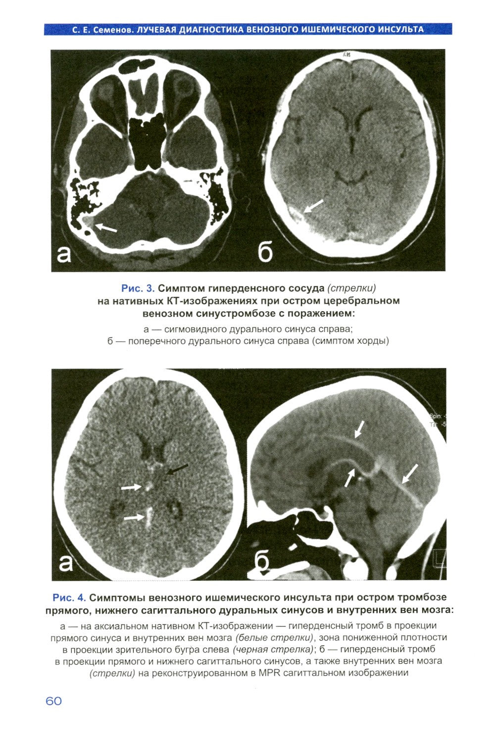 Лучевая диагностика венозного ишемического инсульта