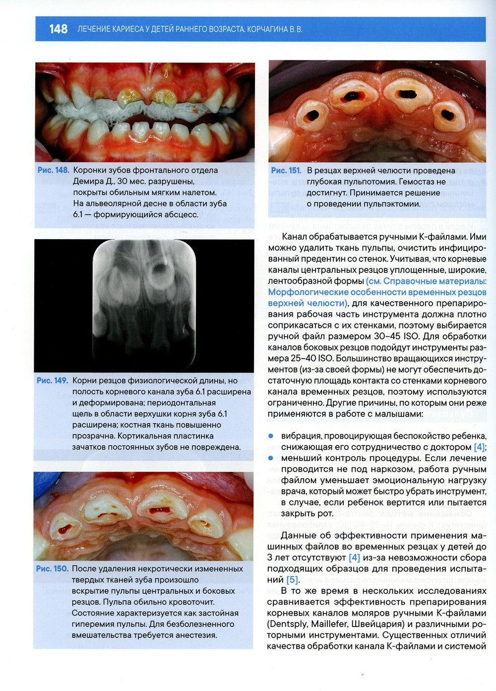 Лечение кариеса у детей раннего возраста