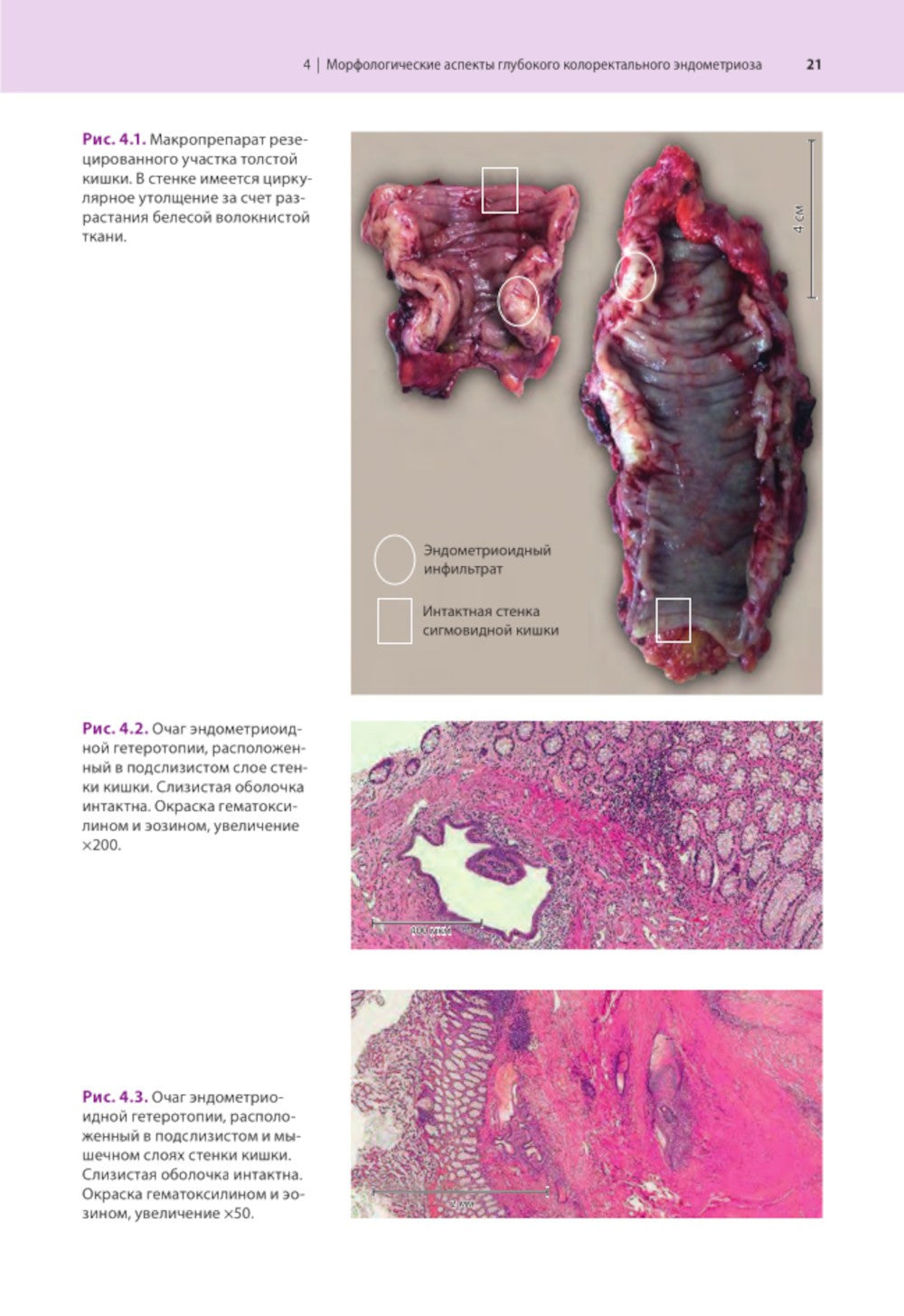 Атлас по эндоскопической диагностике колоректального эндометриоза