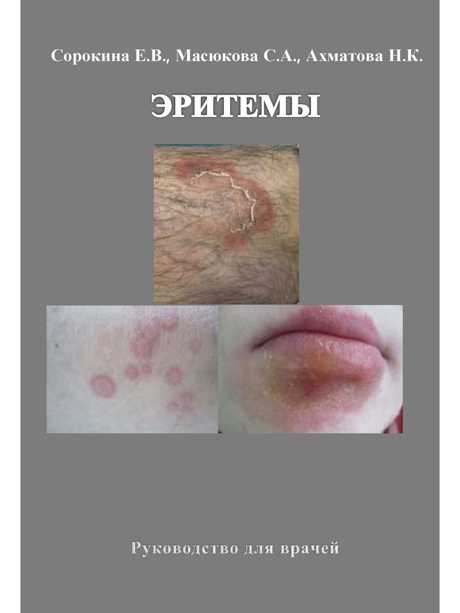 Эритемы. Руководство для врачей
