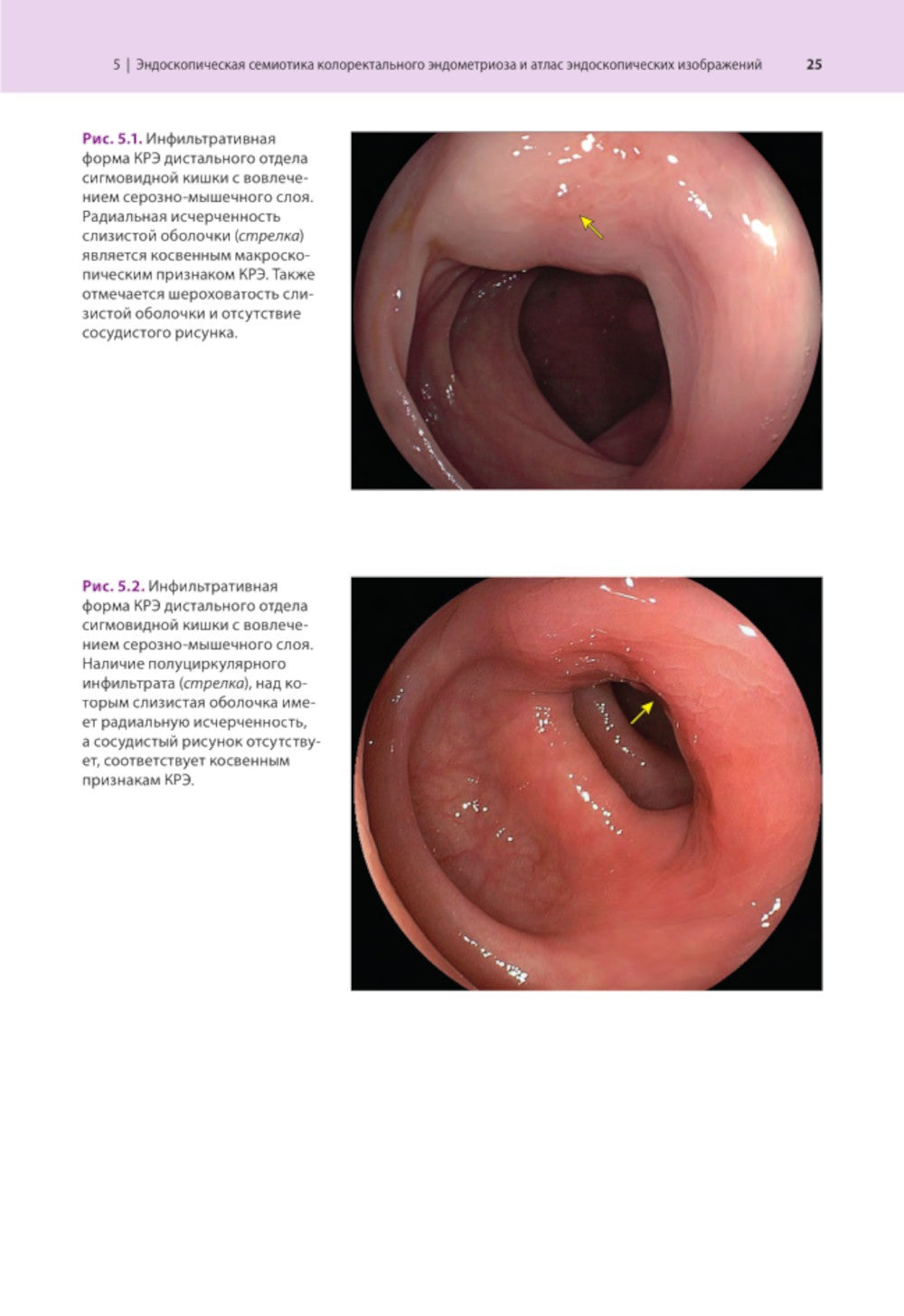 Атлас по эндоскопической диагностике колоректального эндометриоза