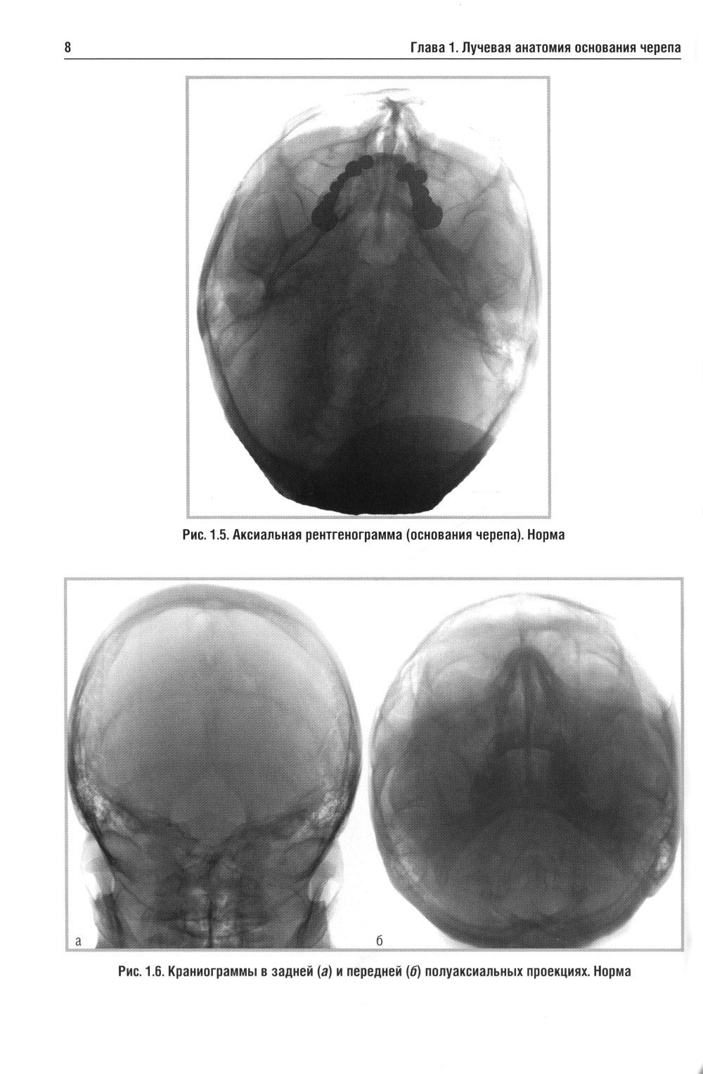 Лучевая диагностика заболеваний оснований черепа и мостмозжечкового угла: Уче...