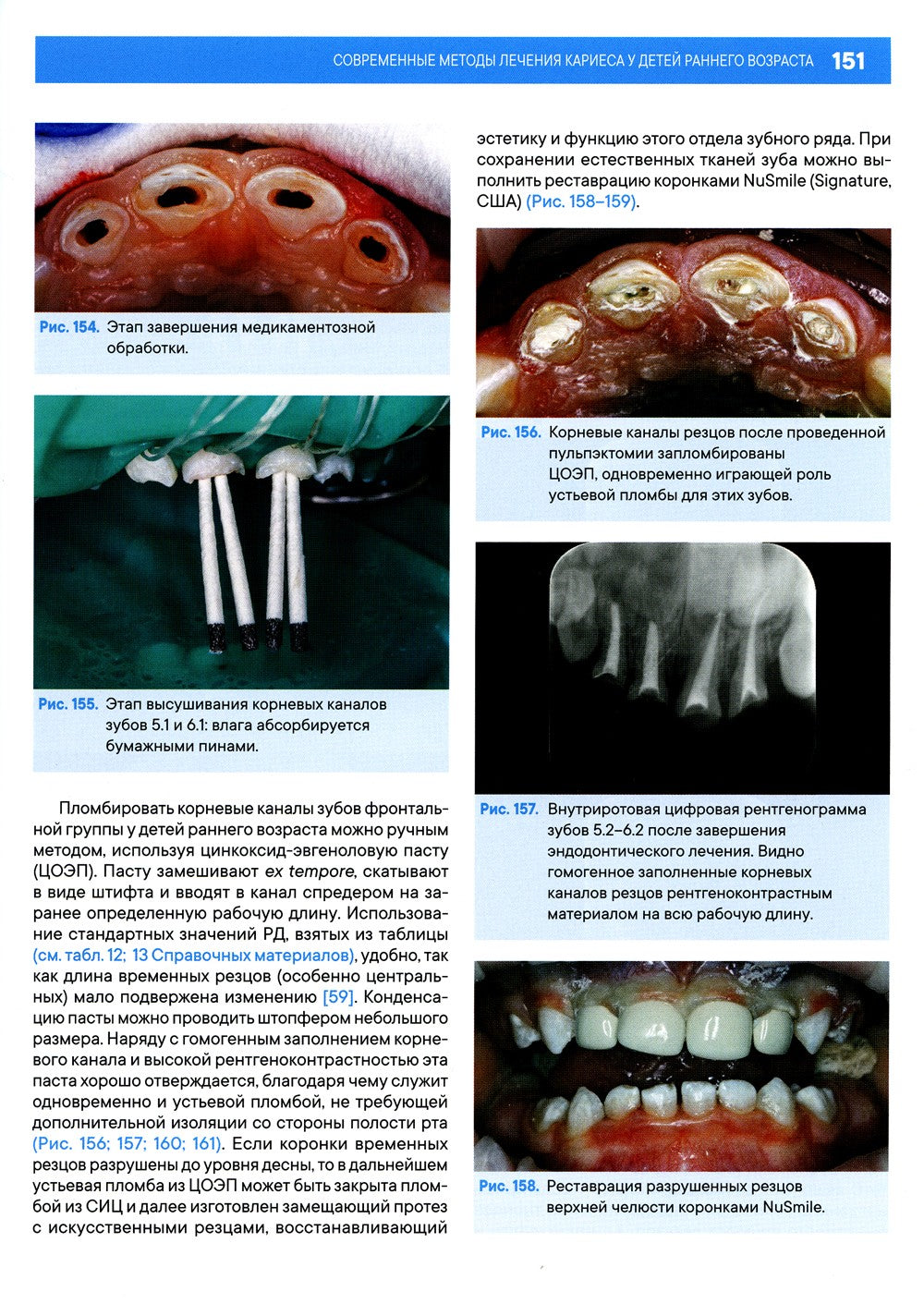 Лечение кариеса у детей раннего возраста