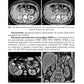 Трудности интерпретации данных КТ и МРТ: печень