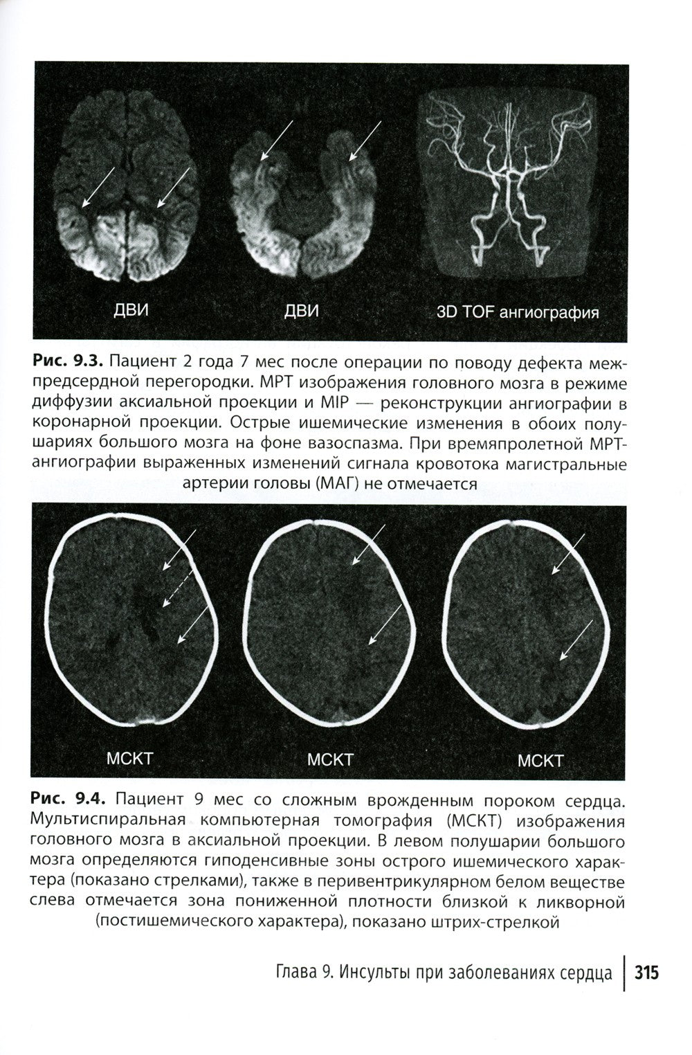 Инсульт и цереброваскулярная патология у детей и подростков: руководство для ...