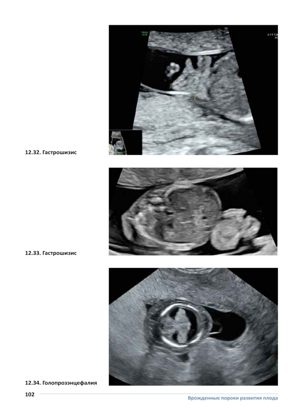 Врожденные пороки развития плода: атлас