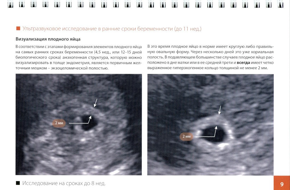 Атлас по ультразвуковой диагностике в акушерстве (эхограммы с комментариями):...