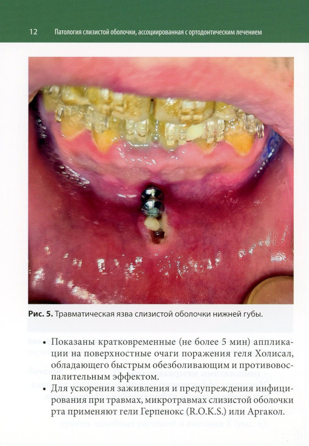 Ортодонтия и патология слизистой оболочки рта