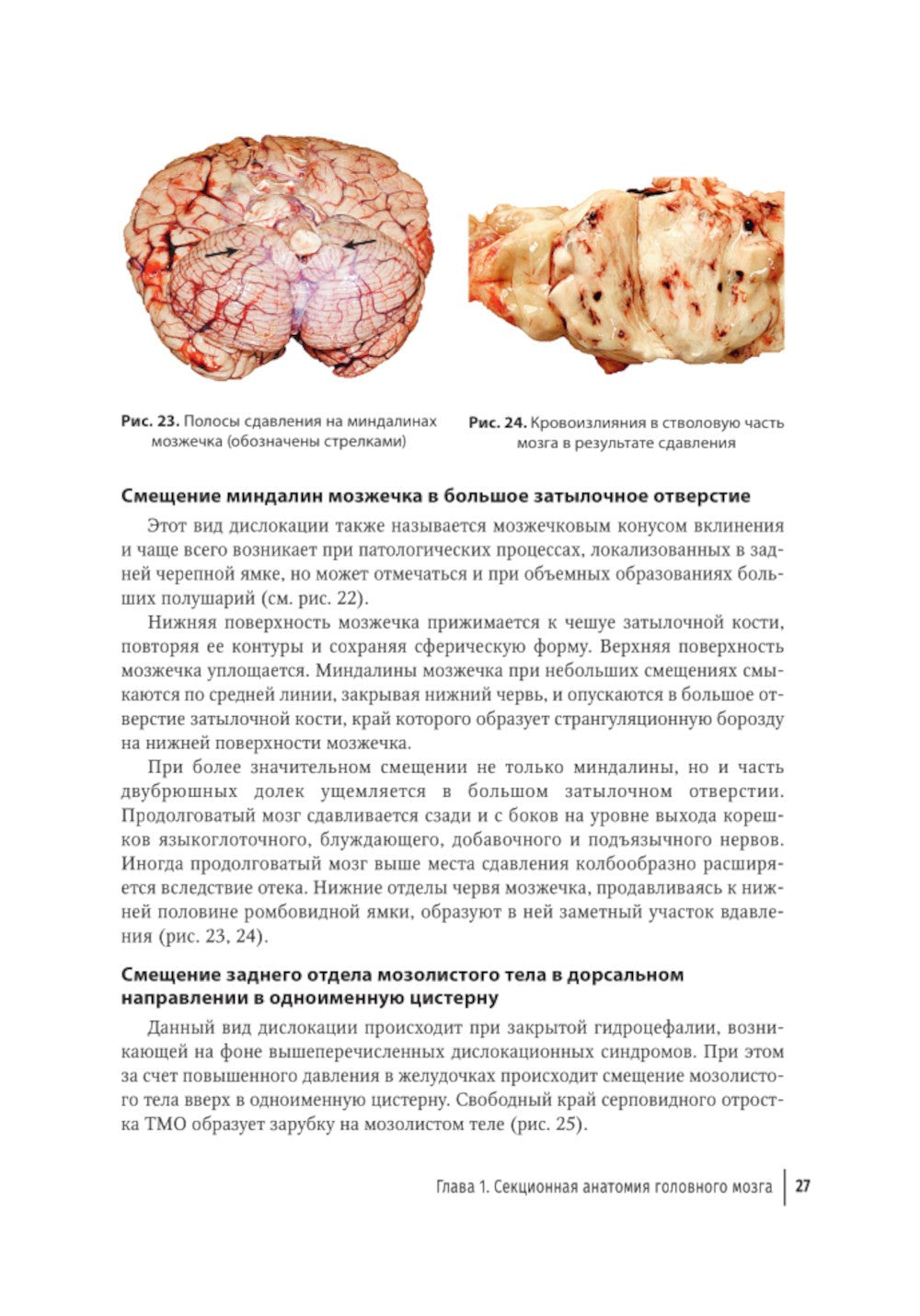 Судебная невропатология. Черепно-мозговая и спинальная травмы: руководство дл...