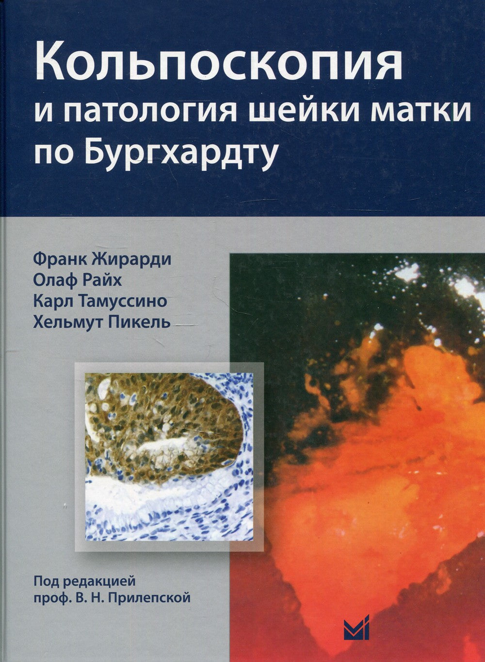 Кольпоскопия и патология шейки матки по Бургхардту