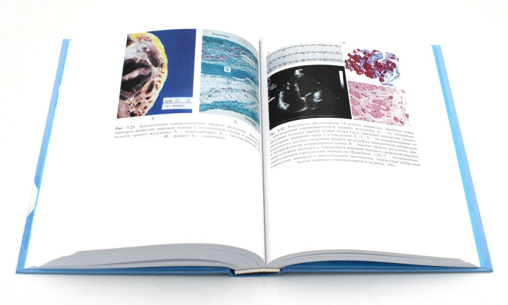 Кардиомиопатии и миокардиты. 2-е изд., перераб. и доп