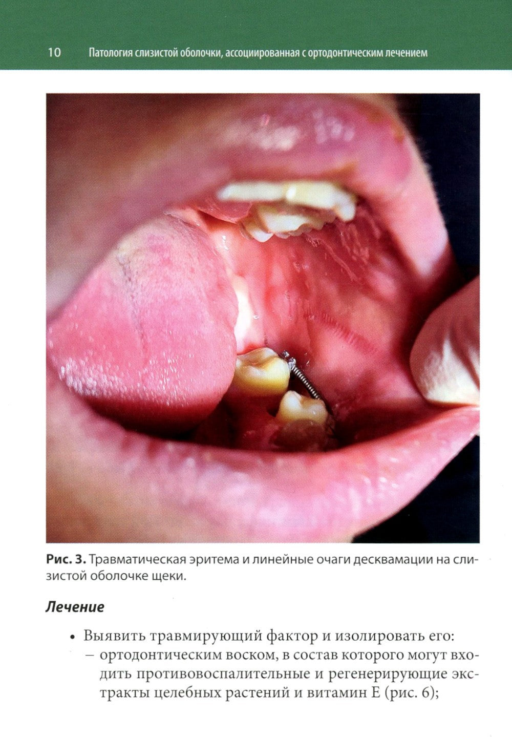 Ортодонтия и патология слизистой оболочки рта