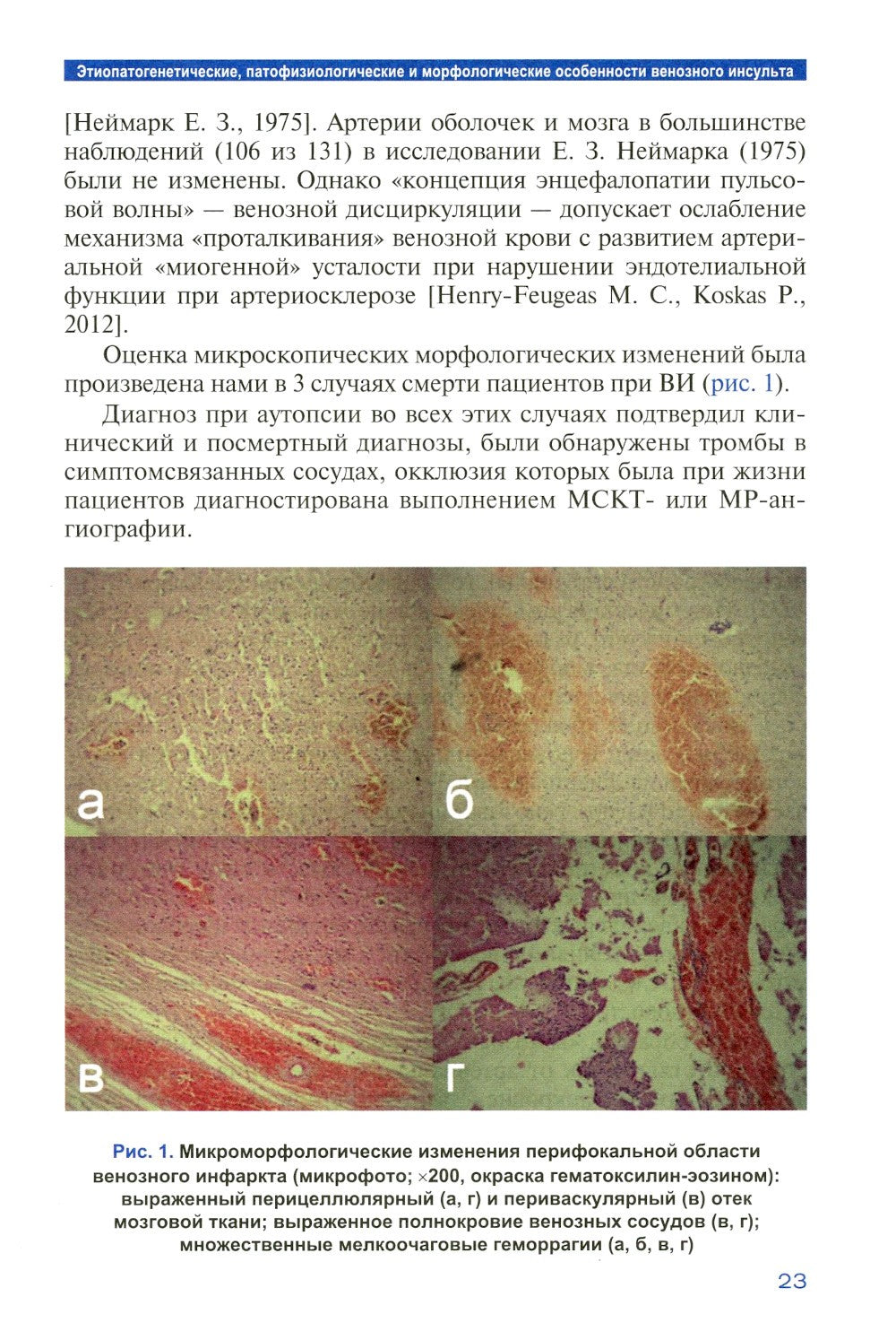 Лучевая диагностика венозного ишемического инсульта