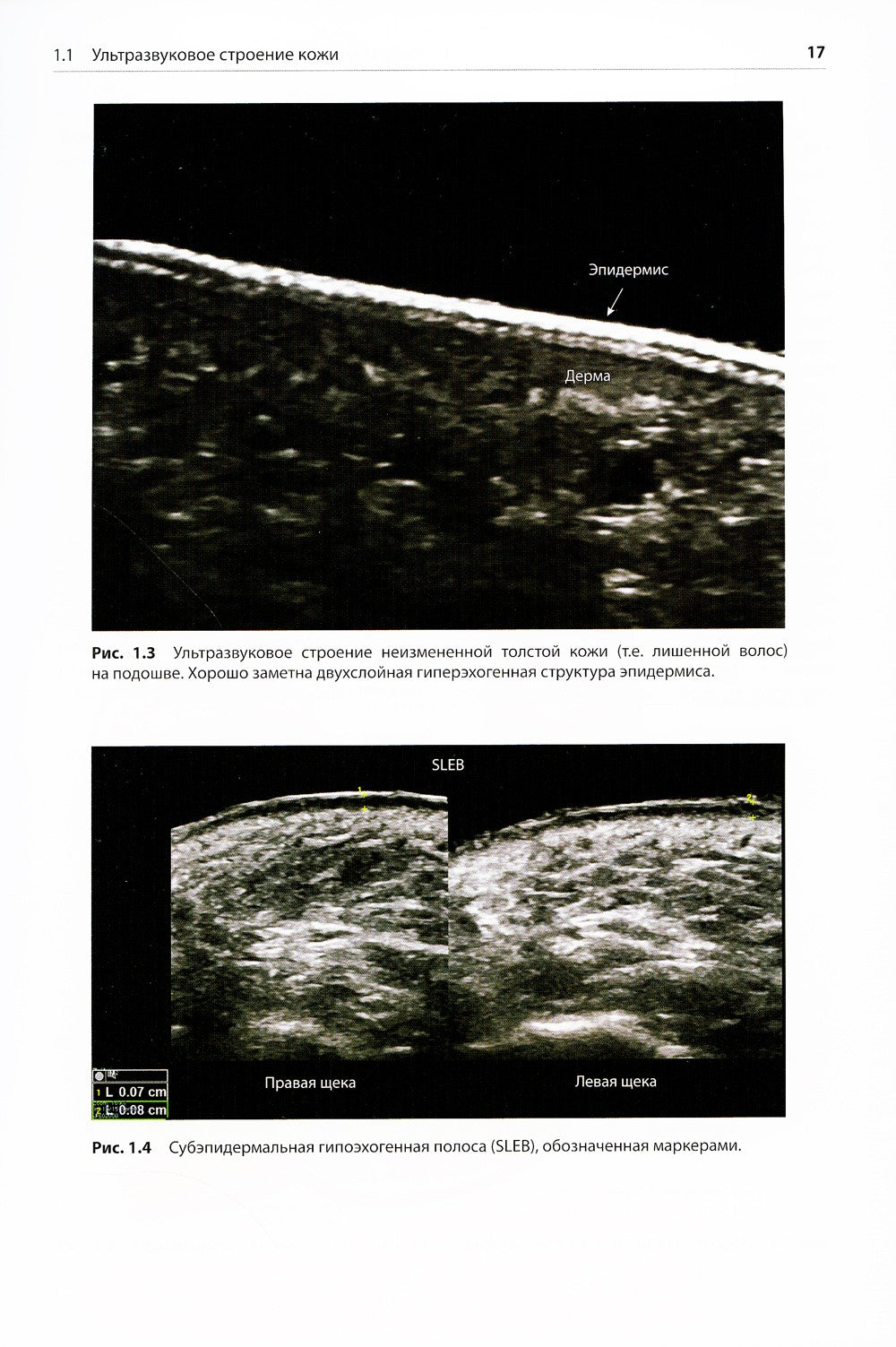 Атлас по ультразвуковому исследованию в дерматологии: мягкие ткани, кожа, при...