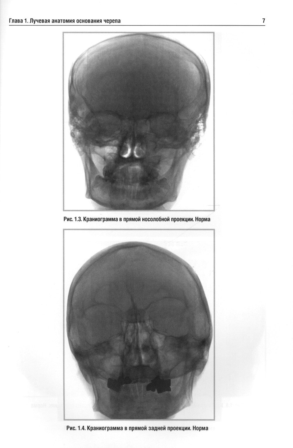 Лучевая диагностика заболеваний оснований черепа и мостмозжечкового угла: Уче...