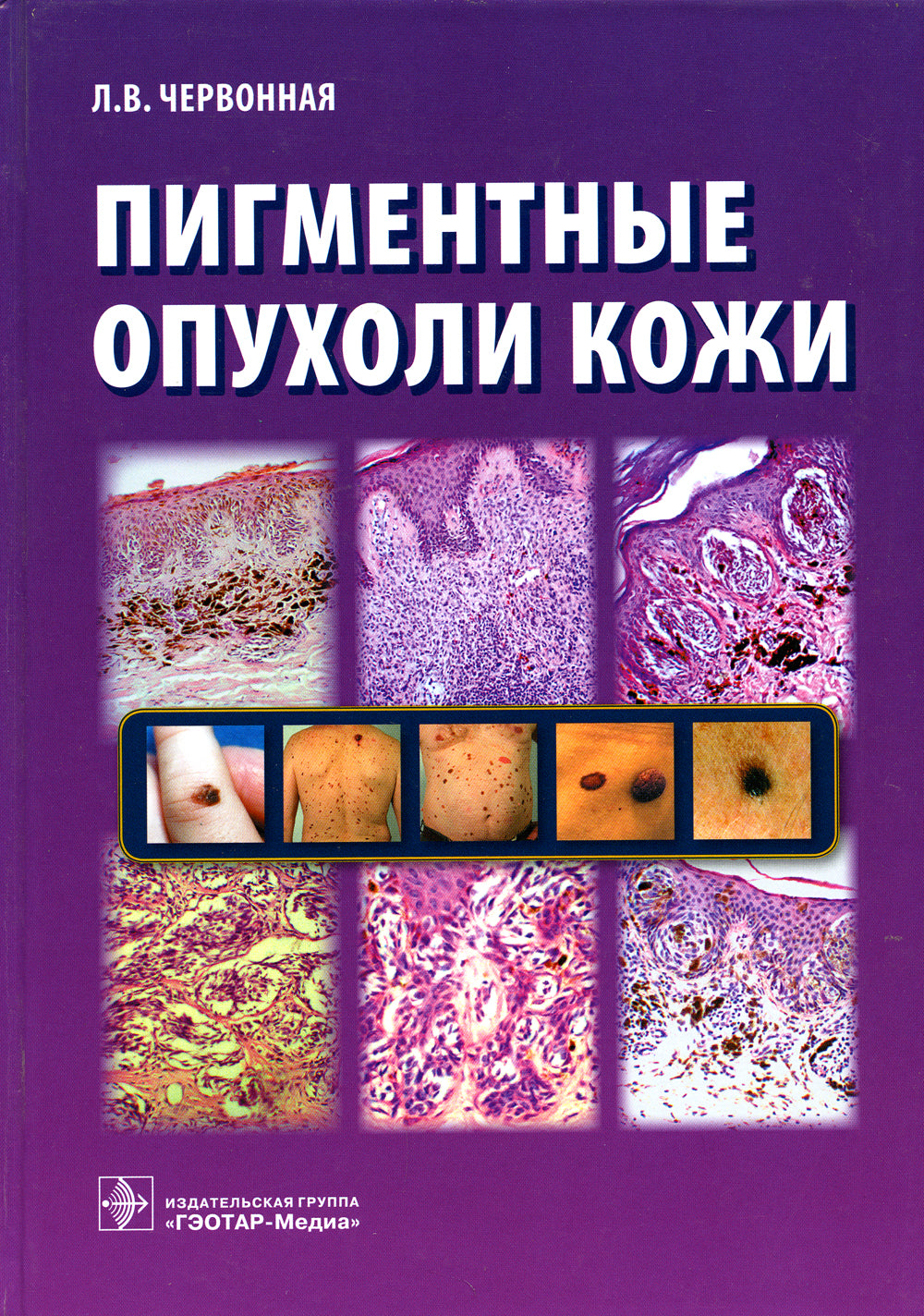 Пигментные опухоли кожи