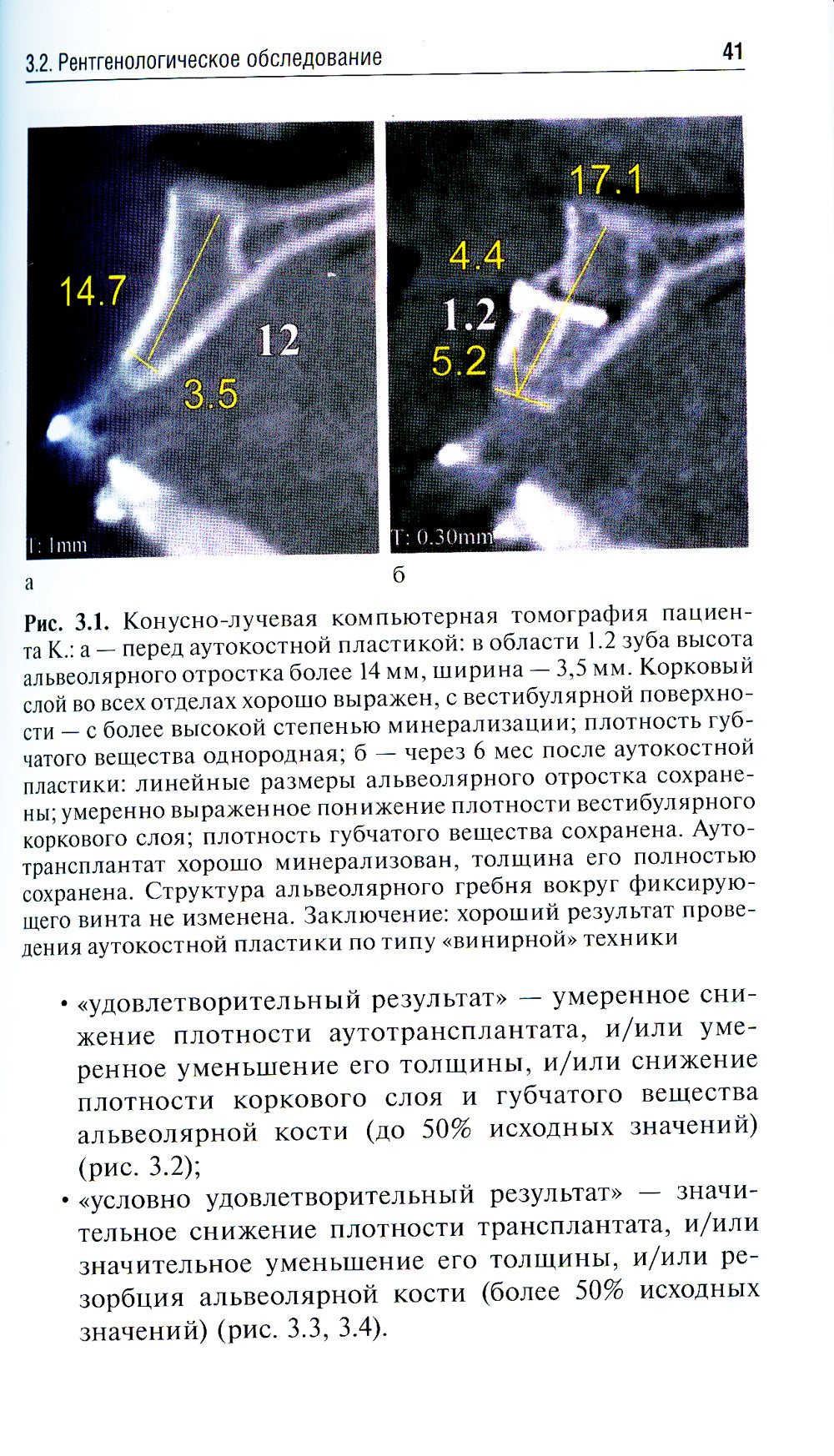 Аутокостная пластика перед проведением дентальной имплантации: Учебное пособие
