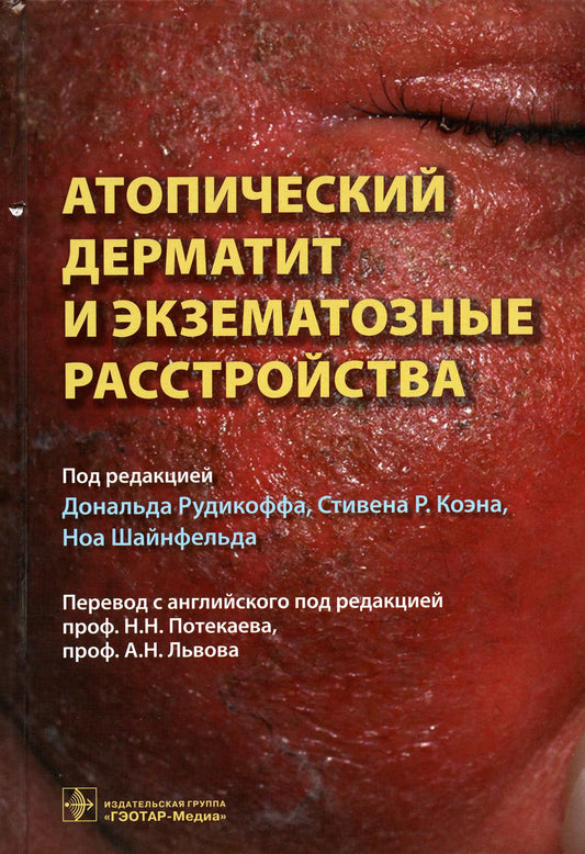 Атопический дерматит и экзематозные расстройства