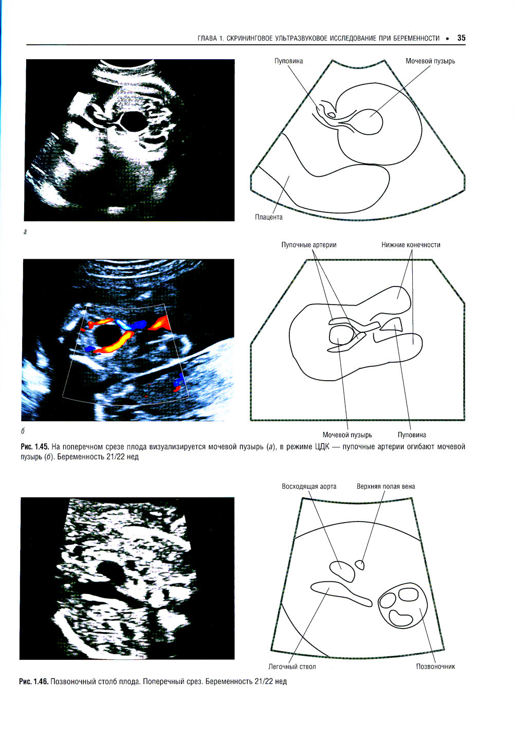Практическая ультразвуковая диагностика: Руководство для врачей. В 5 т. Т. 4. Ультразвуковая диагностика в акушерстве
