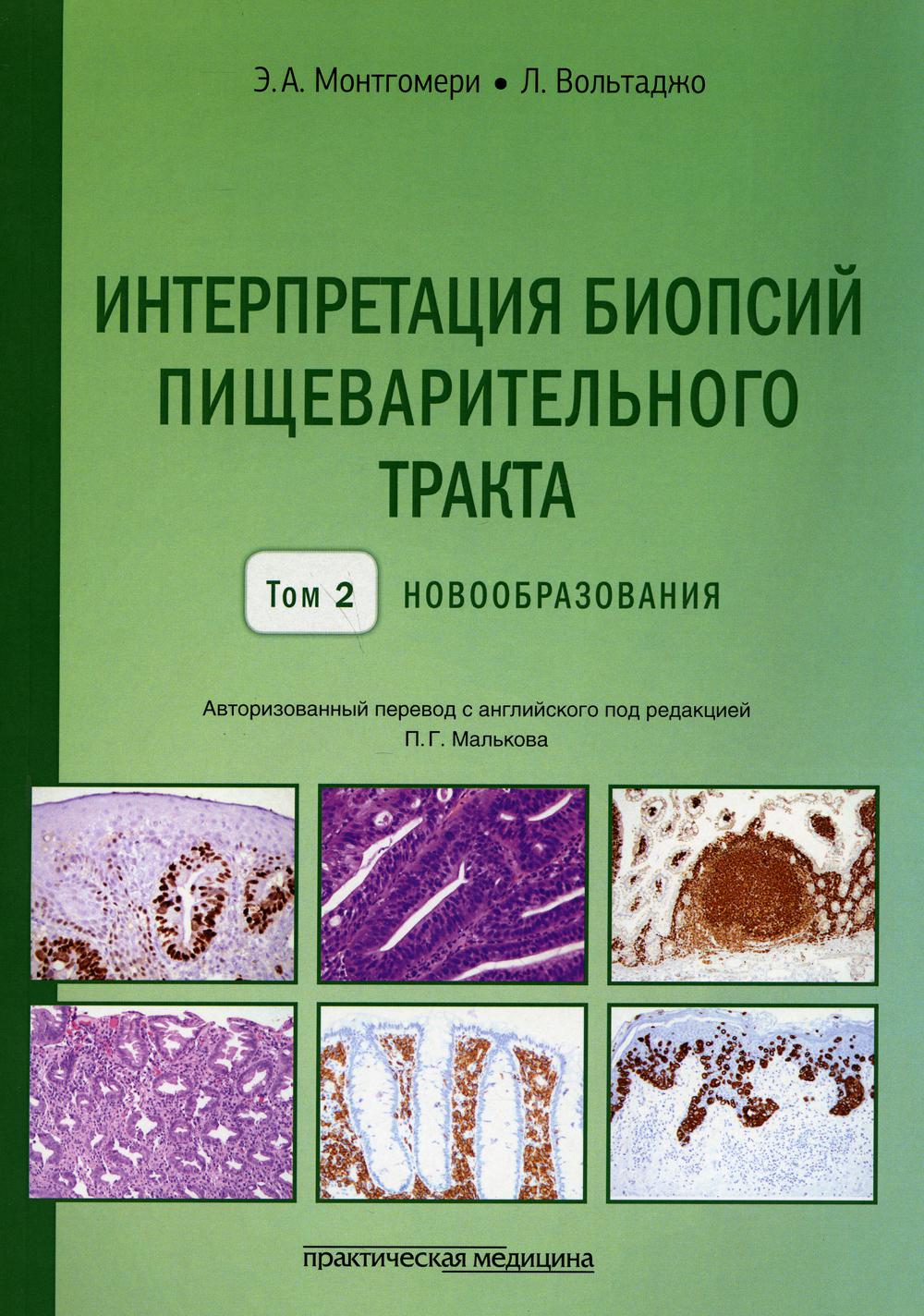 Интерпретация биопсий пищеварительного тракта. Т. 2: Новообразования