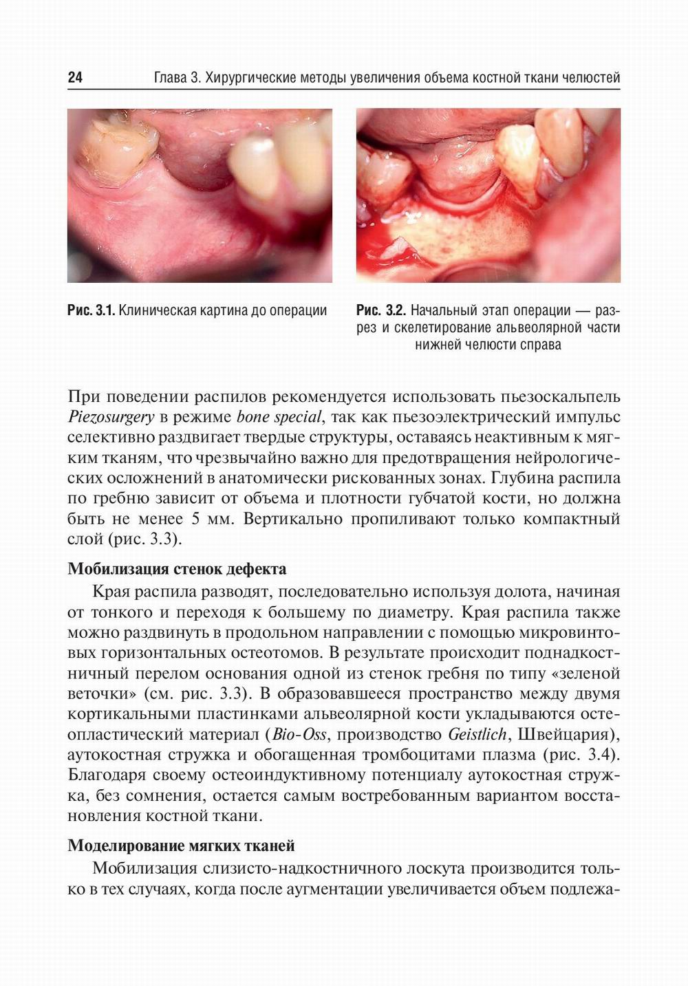 Костная пластика перед дентальной имплантацией: Учебное пособие