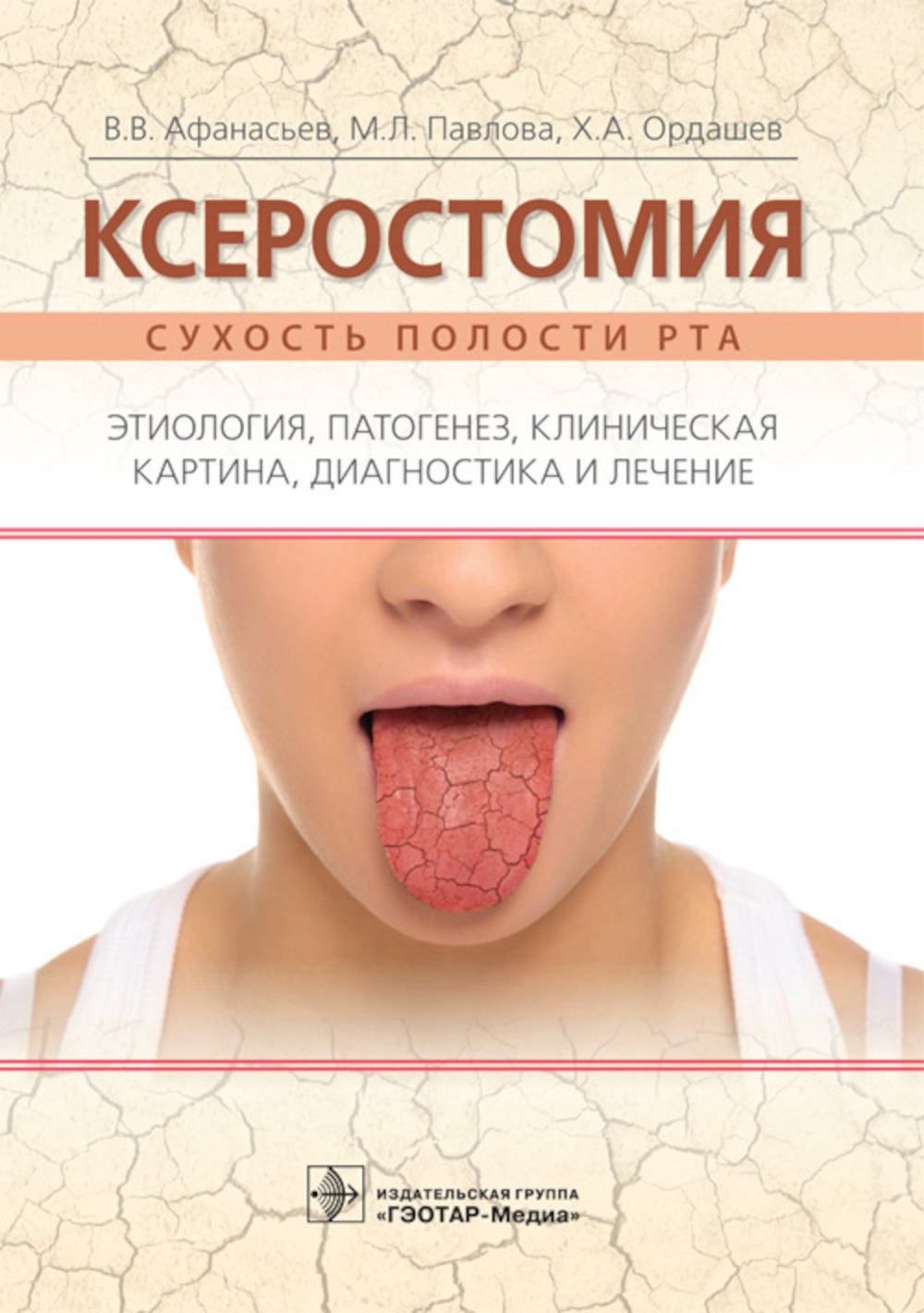 Ксеростомия (сухость полости рта). Этиология, патогенез, клиническая картина, диагностика и лечение