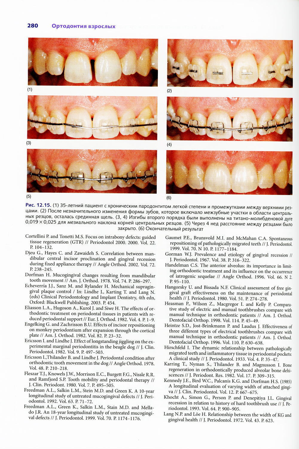 Ортодонтия взрослых